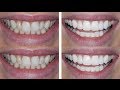 How I Transformed My Teeth!