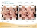 Thermage Eye Lifting &amp; Hooding Reduction Sydney