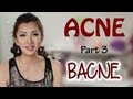 How to Get Rid of Bacne!