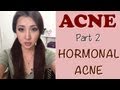 How To Control Hormonal Acne