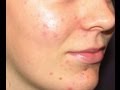 Skin Care - Acne Home Remedy Using Aromatherapy