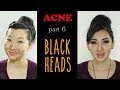Acne: How to properly extract and prevent Blackheads