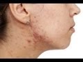 Remedy For Acne - Cosmetic Treatment, Care And Diet